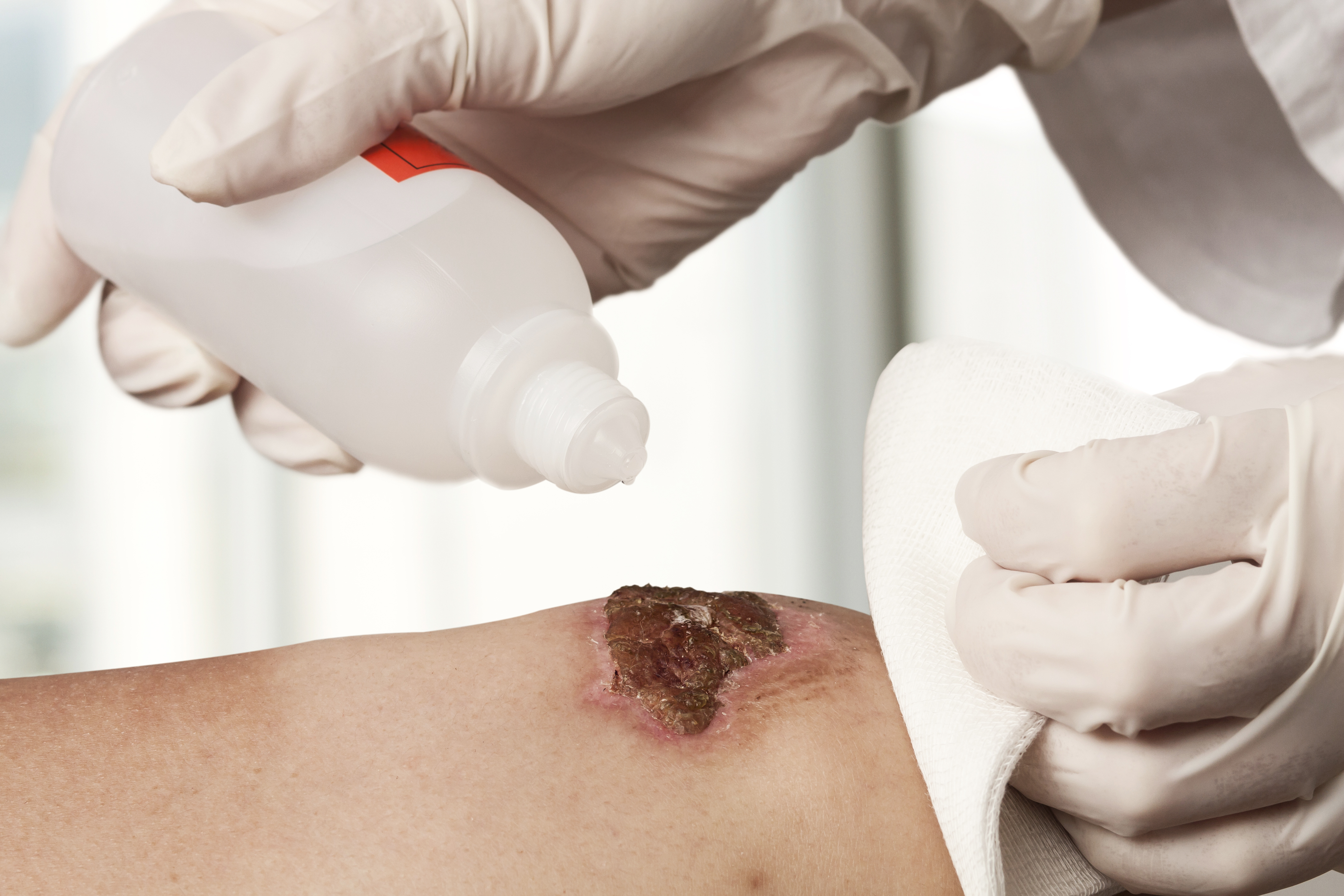 The Role of Wound Cleansers in Wound Management